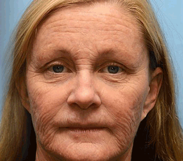 Made and dispatched in the UK✨ 𝗧𝗟𝗢𝗣𝗔® Botox Bee Venom Wrinkle Removal Cream👨‍⚕️𝐌𝐇𝐑𝐀 𝐑𝐞𝐜𝐨𝐦𝐦𝐞𝐧𝐝𝐞𝐝✨LAST DAY 80% OFF